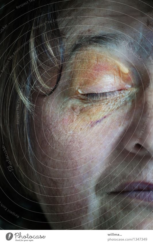 Sturzverletzung im Gesicht , Bluterguss, auch Veilchen genannt Blaues Auge (Bluterguß) Frau Erwachsene Weiblicher Senior Schmerz Gewalt Unfall Prellung