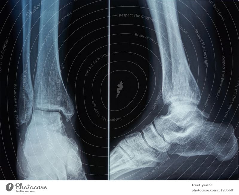 Knochenscan eines Fußes Körper Gesundheitswesen Seniorenpflege Krankheit Medikament Wellness Wissenschaften Prüfung & Examen Arzt Krankenhaus