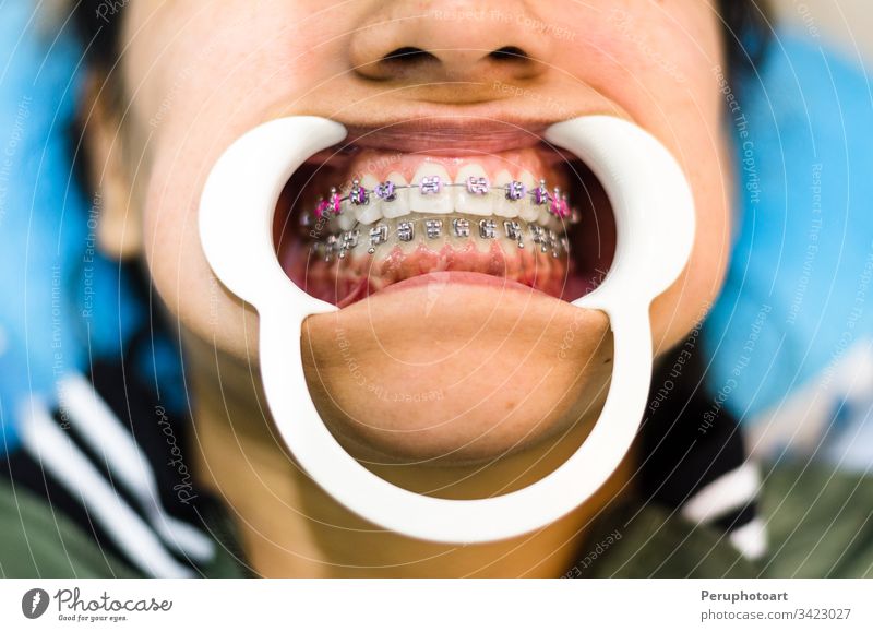 Nahaufnahme der Zähne einer jungen Frau mit Zahnspange und Retraktor für den Mund. Halterungen dental Aufroller Erwachsener Zahnarzt schön Pflege Keramik