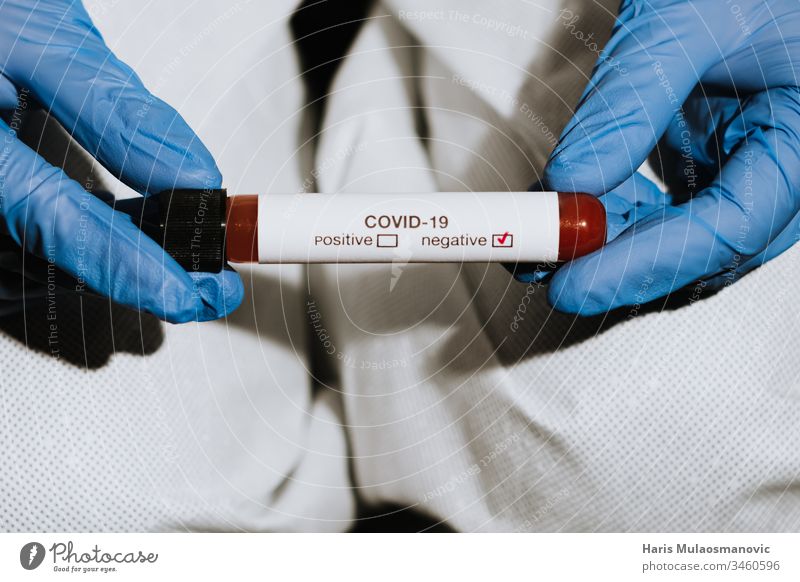 Nahaufnahme eines Reagenzglases mit Blut in der Hand eines Arztes mit negativem Test auf Coronavirus covid-19 Blutprobe Klinik Korona-Epidemie corona italy