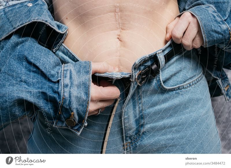 junges, schlankes Mädchen zeigt nach der Operation eine Narbe am Bauch. Frau in modischer Kleidung: Jeansjacke und -hose im Frühling Unterleib abdominal