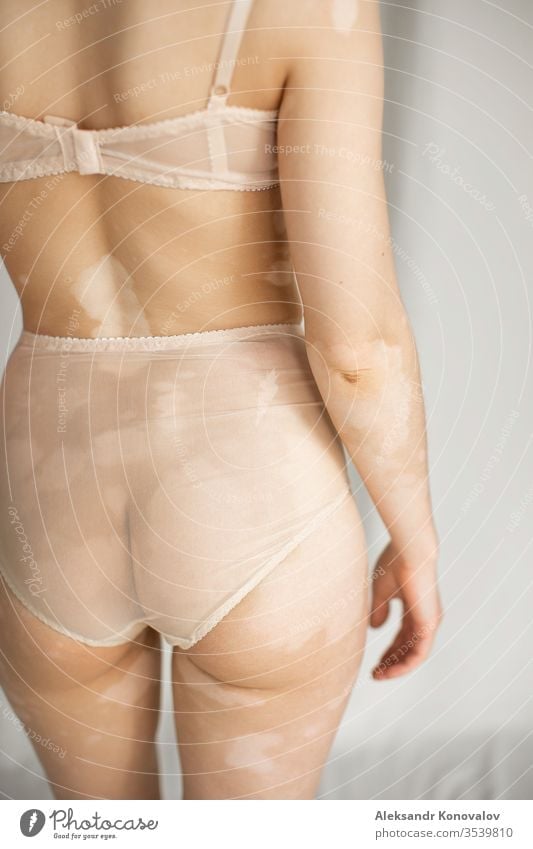 Junge Frau mit blasser Haut und Vitiligo steht auf Stoffhintergrund im natürlichen Licht in transparenter Unterwäsche Körper Schönheit schlank schön weiß nackt