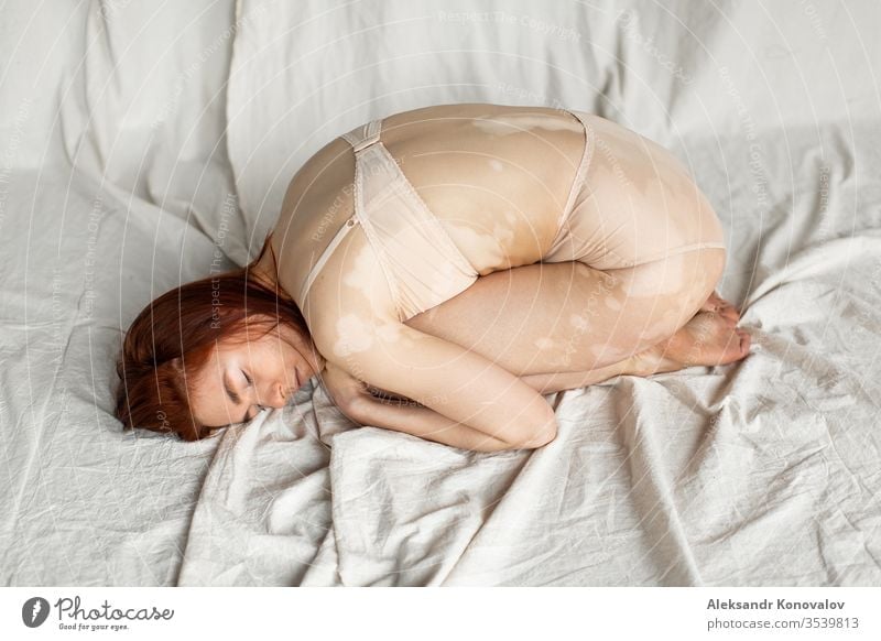 Junge Frau mit blasser Haut und Vitiligo posiert im natürlichen Licht in transparenter Unterwäsche Körper Schönheit schlank schön weiß nackt vereinzelt jung