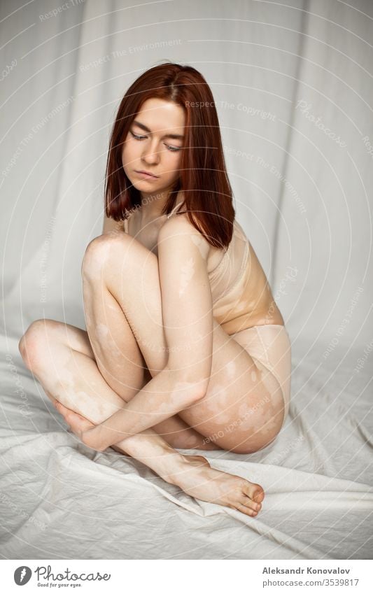 Junge Frau mit bleicher Haut und Vitiligo sitzt auf Stoffhintergrund bei natürlichem Licht in transparenter Unterwäsche Körper Schönheit schlank schön weiß