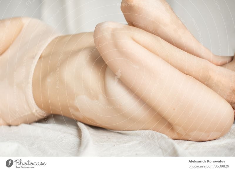 Junge Frau mit blasser Haut und Vitiligo posiert im natürlichen Licht in transparenter Unterwäsche Körper Schönheit schlank schön weiß nackt vereinzelt jung