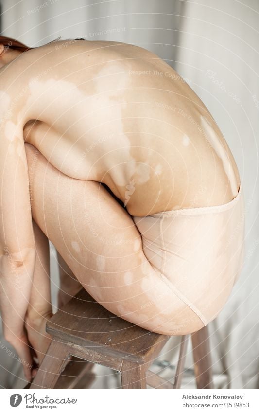 Junge Frau mit bleicher Haut und Vitiligo sitzt auf Stoffhintergrund bei natürlichem Licht in transparenter Unterwäsche Körper Schönheit schlank schön weiß