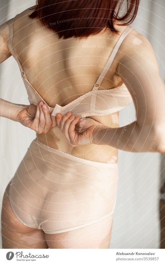 Junge Frau mit blasser Haut und Vitiligo steht auf Stoffhintergrund in natürlichem Licht in transparenter Unterwäsche und schließt ihren BH Körper Schönheit