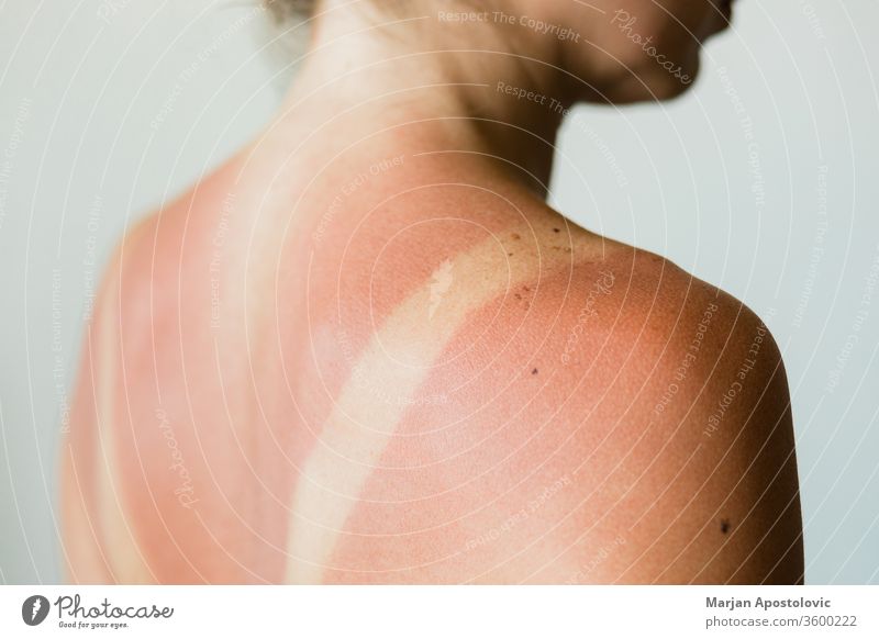 Nahaufnahme eines Sonnenbrandflecks auf dem Rücken einer Frau Detailaufnahme Grundriss Spuren Menschen vereinzelt ultraviolett Sonnenlicht Bräunen Schönheit