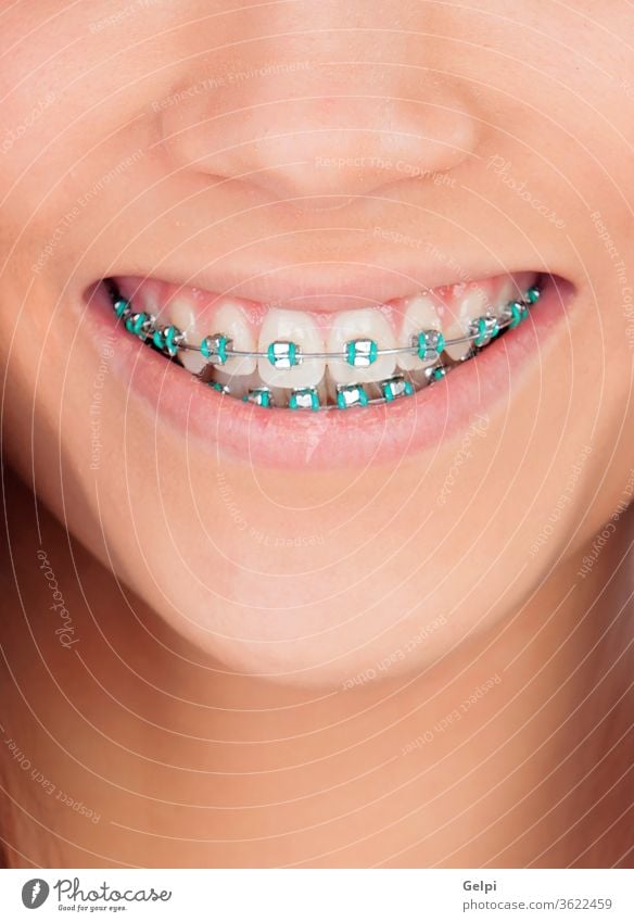 Bildnis eines jungen Mädchens mit Klammern dental Mund Frau weiß schön Lächeln Glück Lippen Gesundheit Schönheit Metall Hygiene Nahaufnahme kieferorthopädisch