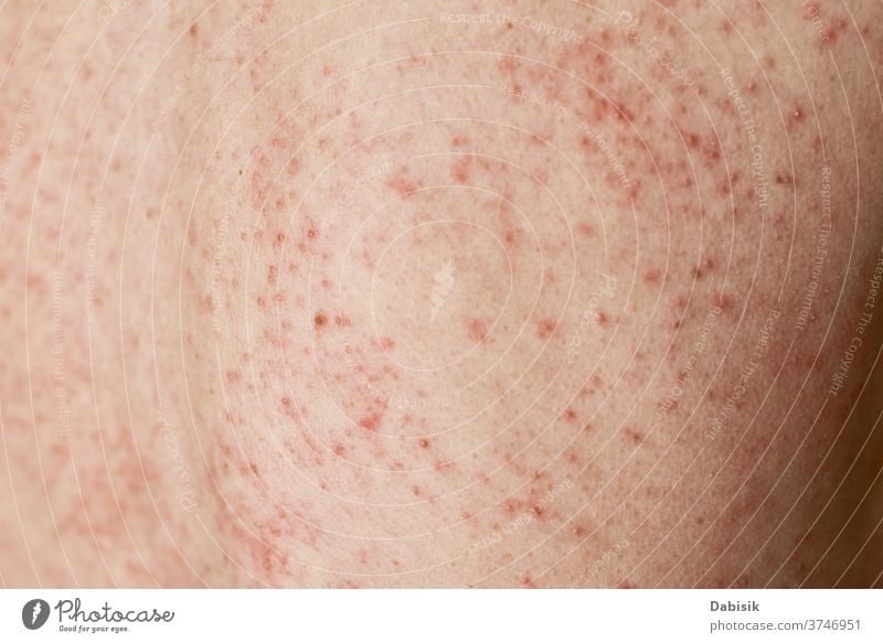 Allergischer Ausschlag auf der Haut. Frau mit dermatologischem Problem auf der Rückenhaut überstürzt Allergie Hautausschlag Dermatologie Infektion Krankheit