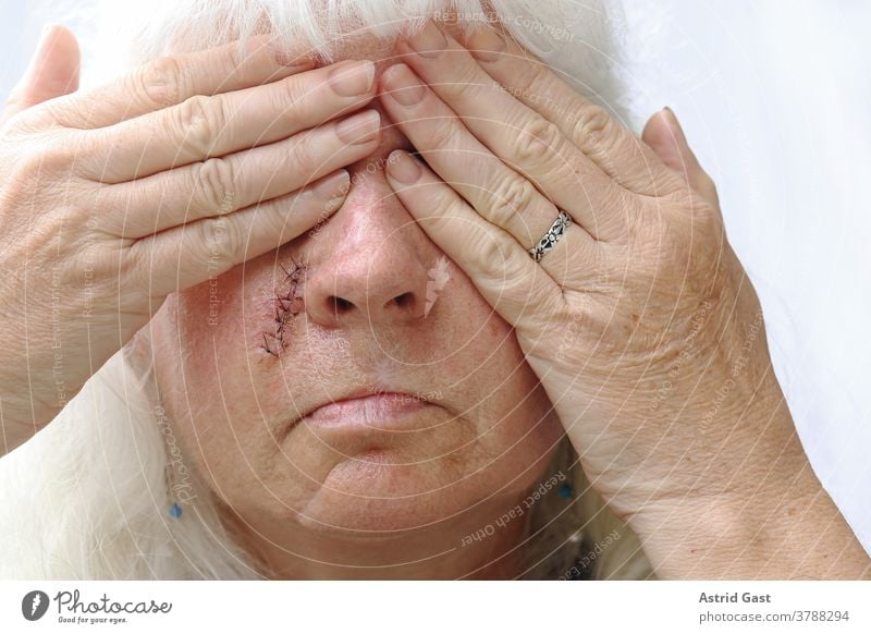 Bei Narben im Gesicht möchte man sich am liebsten verstecken. Eine ältere Frau hat eine Narbe im Gesicht und schämt sich dafür basalzellkarzinom belastung