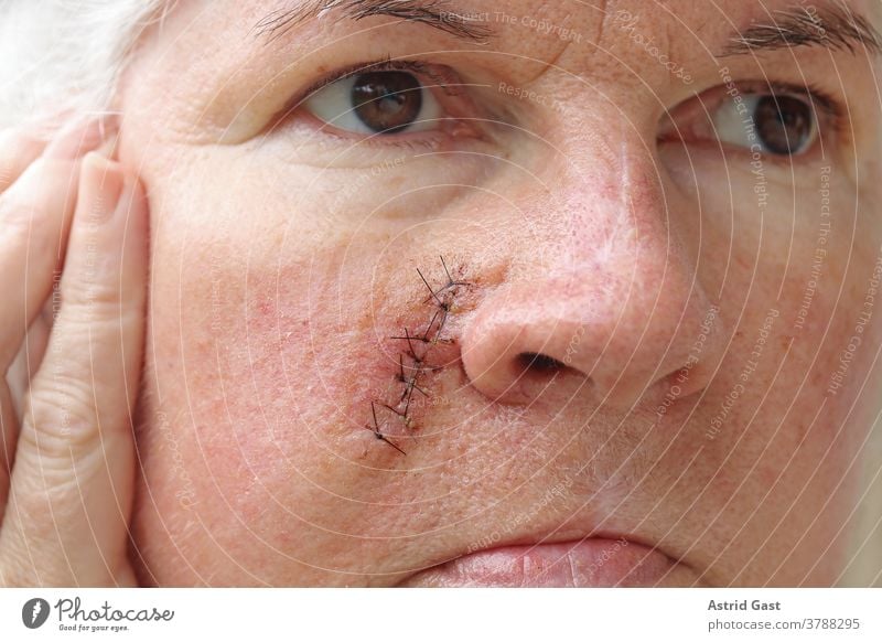 Eine ältere Frau hat eine Operationsnarbe im Gesicht gesicht haut frau seniorin operationsnarbe narben naht fäden unfall nähen riss operationsnaht hautkrankheit