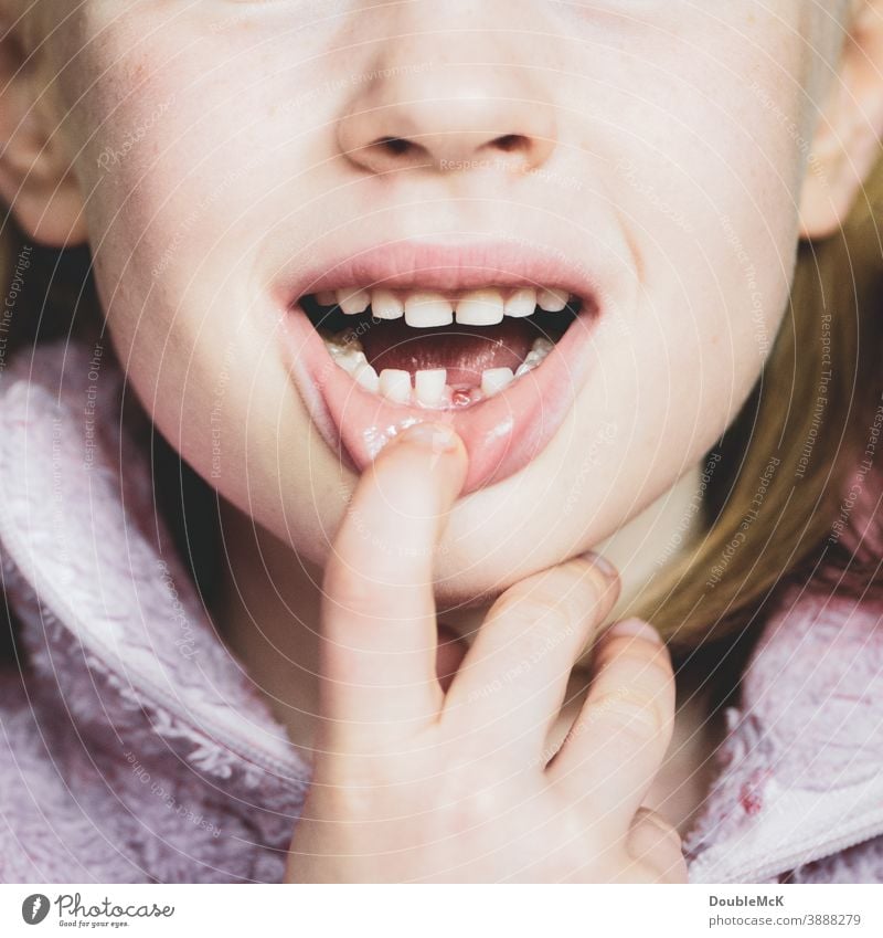 Mädchen zeigt Zahnlücke, da sie den ersten Milchzahn verloren hat Milchzähne Kind Kindheit Zähne Mund Farbfoto Lippen 3-8 Jahre Kopf Gesicht Mensch Fröhlichkeit