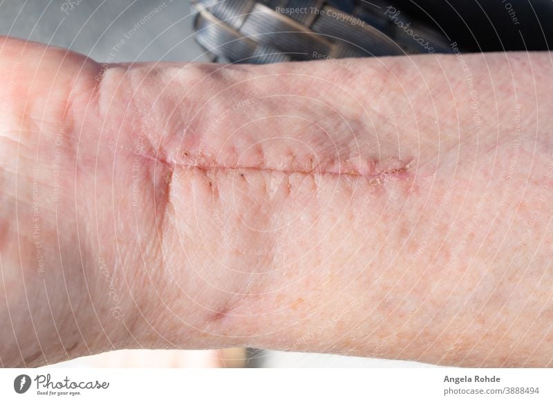 Narbe am Handgelenk einer Frau Chirurgie Operation Gesundheit Dermatologie Medizin Schmerz menschlich Krankenhaus geduldig Wunde Unfall Haut Behandlung Pflege