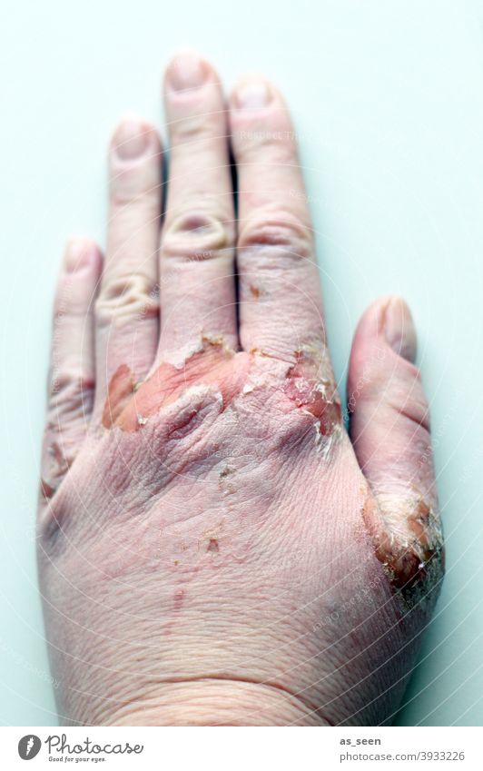 Brandwunde Wunde Haut verbrannt Feuer Flamme Gefahr verwundet Hand Finger krank verletzt Verletzung rosa türkis pastell geschwollen Verbrennung Wundheilung