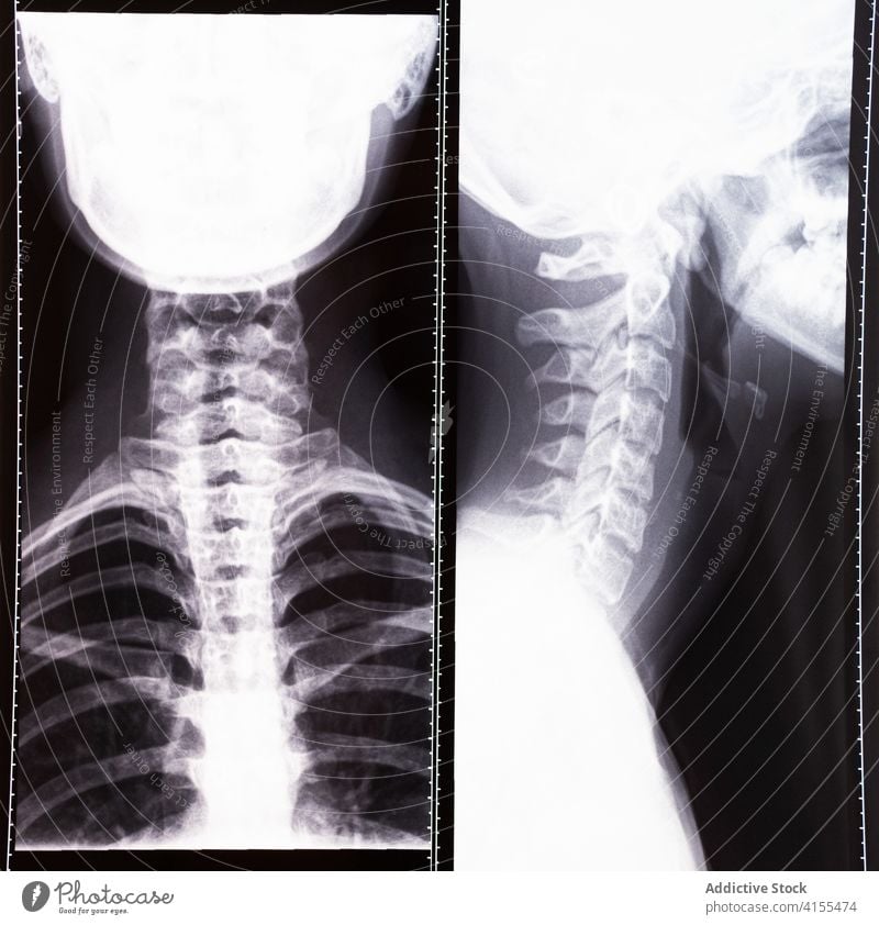 Röntgenbild der Nacken-Halswirbelsäule Stachel Spalte Schädel Medizin Gesundheitswesen Diagnostik Scan mri Bild medizinisch Leckerbissen menschlich Körper