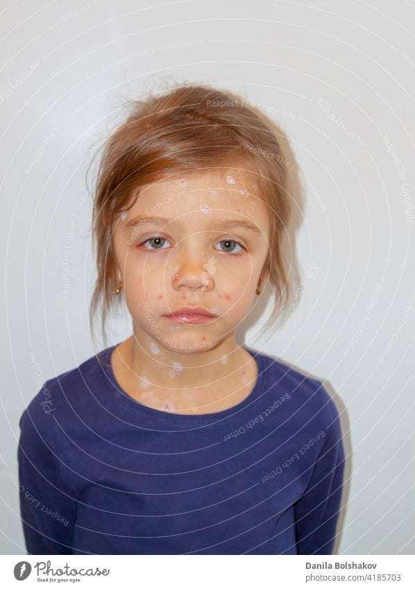 Trauriges kleines Mädchen krank mit Varizellen-Virus oder Windpocken Blasenausschlag im Gesicht viral pädiatrisch in die Kamera schauen