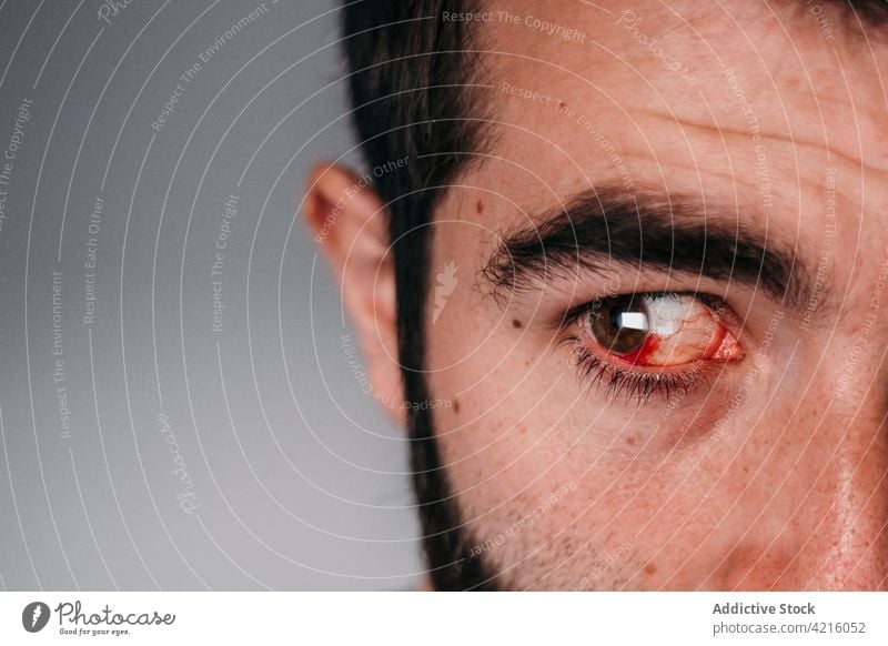 Mann mit blutunterlaufenem Auge schaut weg rot Vene entzünden verärgern Infektion krank Verletzung männlich entzündet ungesund Problematik Symptom Krankheit