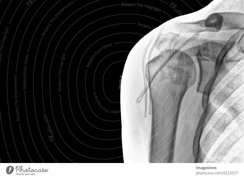 Röntgenaufnahme Schulter auf schwarzem Hintergrund. Chronische Luxation der langen Bizepssehne nach der Operation. SSC Sehnenkorkenzieher Anker. invertiertes Bild