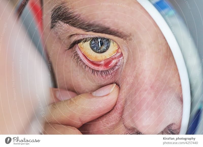 Menschliches Auge mit gelbem Augapfel, Nahaufnahme. Gelbe Augen sind ein Symptom für eine Lebererkrankung oder Hepatitis menschliches Auge gelbe Augen Blickfang