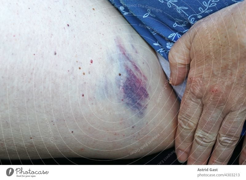 Eine Frau hat an der Schenkelinnenseite eine große schmerzhafte Prellung (blauer Fleck) frau bein schenkel blauer fleck prellung geprellt verletzung wunde