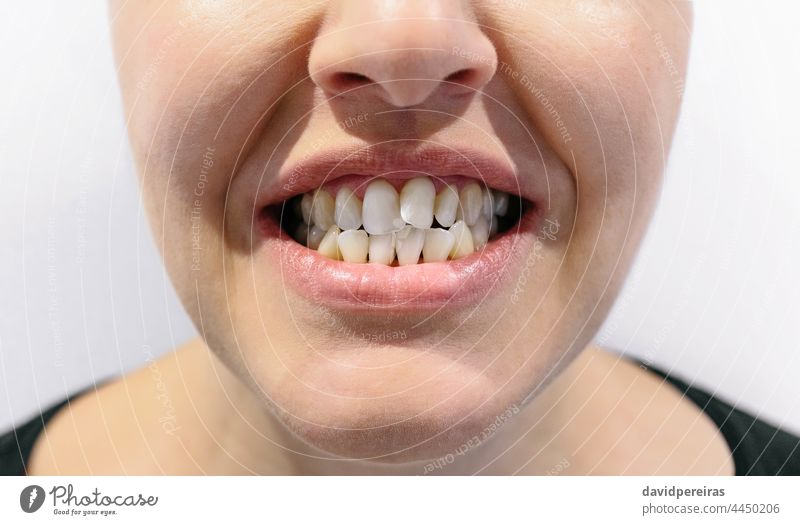 Mund einer Frau mit Engstand der Zähne schiefer Zahn Zahnüberhang unkenntlich kieferorthopädisch dental Problematik Zahnfleischeinfassungen hässlich Lächeln
