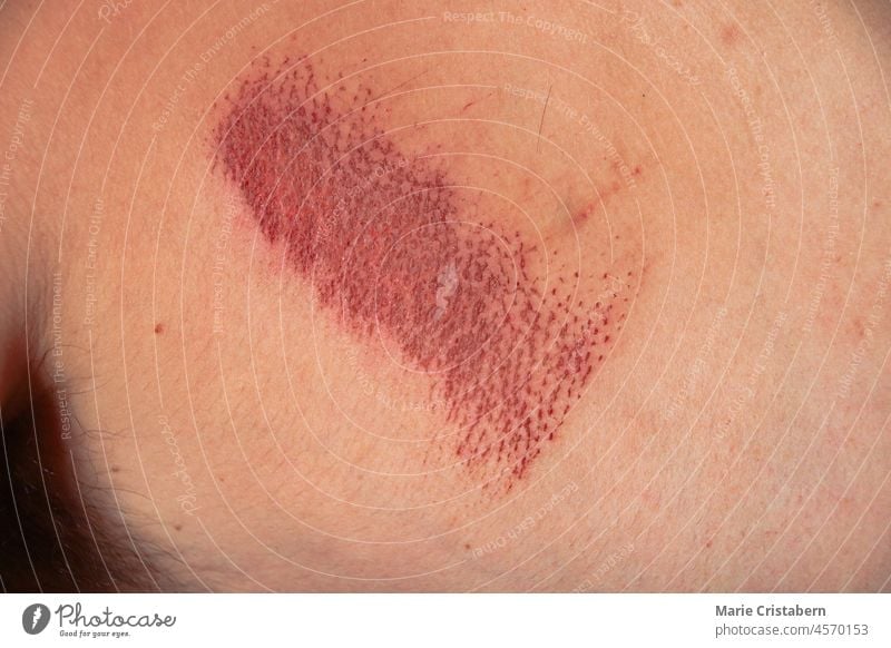 Nahaufnahme einer Schürfwunde in kaukasischer Haut Kaukasier Hautverletzung abschließen medizinisch Gesundheitswesen Hautabschürfung Hautbild Muster rau