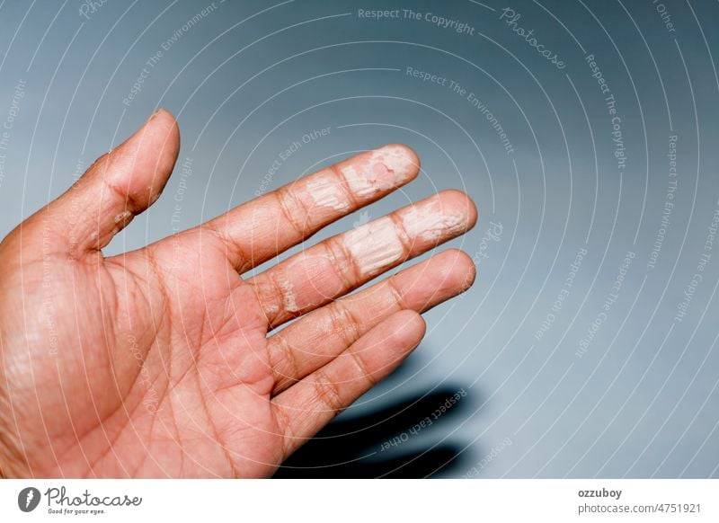 Trockene Haut an den Händen, Peeling, Kontaktdermatitis, Pilzinfektionen Hand trocknen Gesundheit Dermatologie medizinisch Dermatitis Voraussetzung Hintergrund