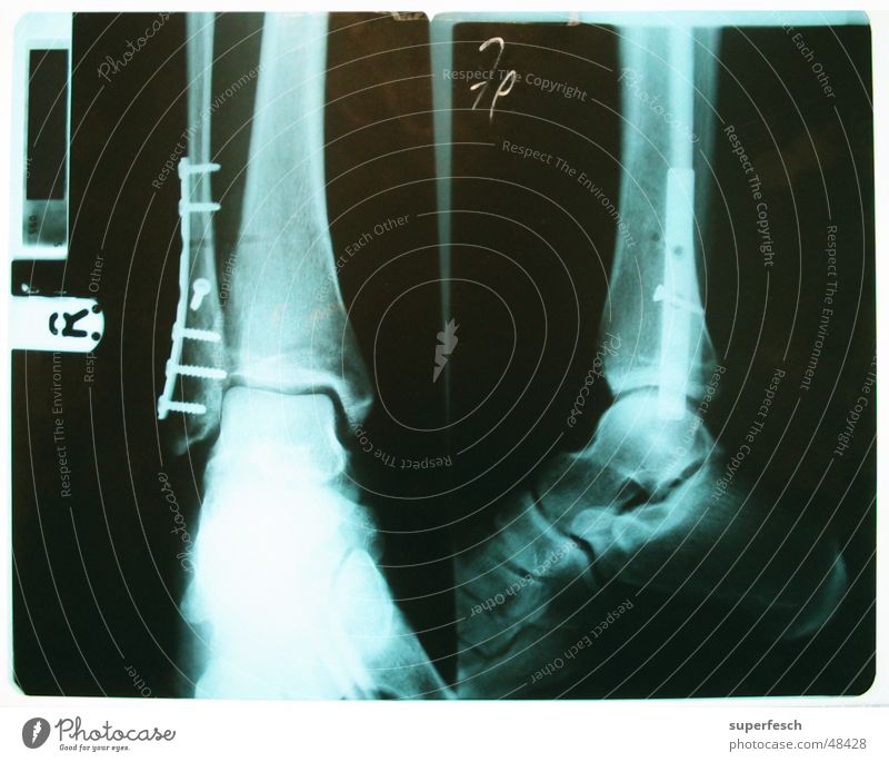 Alles wird gut. brechen rehabilitatieren Operation gebrochen Beine Fuß Fußknöchel Schraube Radiologie