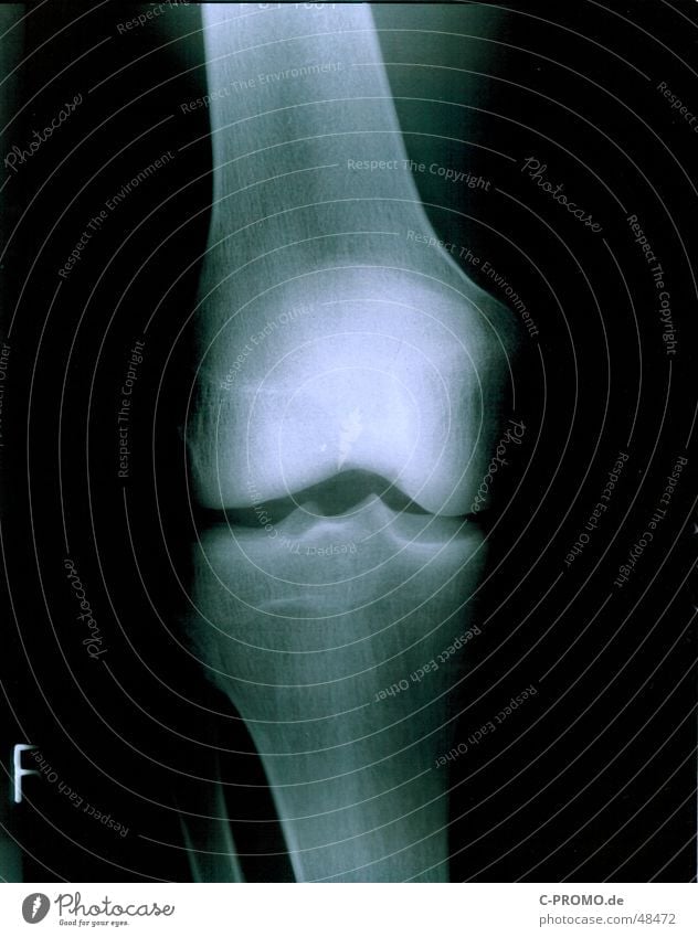 Mein rechtes Knie :: my right knees Gesundheitswesen Arzt Gelenk kaputt Kniescheibe Skelett Strahlung schwarz Licht weiß chirog Mensch durchleuchten Schmerz