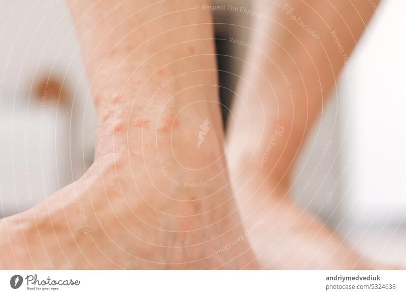 Nahaufnahme allergischer Hautausschlag Dermatitis Ekzem auf Mann Fuß. Bein mit rotem Ausschlag, verursacht durch Insektenstiche. Dermatitis, Follikulitis, Pilzinfektion. Betroffene Hautpartie wird rot und fleckig und schwillt an