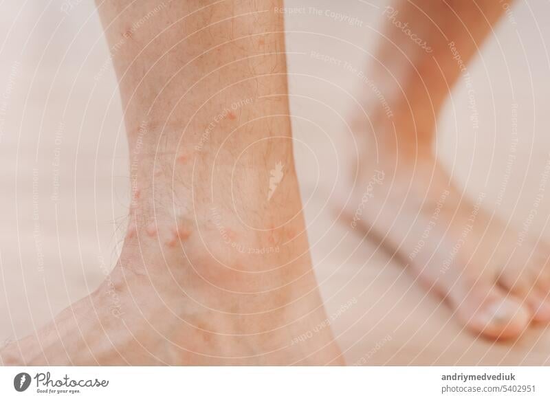 Nahaufnahme allergischer Hautausschlag Dermatitis Ekzem auf Mann Fuß. Bein mit rotem Ausschlag, verursacht durch Insektenstiche. Dermatitis, Follikulitis, Pilzinfektion. Betroffene Hautpartie wird rot und fleckig und schwillt an