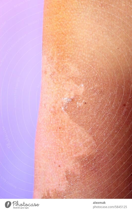 Brandwunde an der Hand nach Sonnenbrand verbrannt Gesundheitswesen Körper Konsequenz Haut verbrühen übertrieben rot rosa Sommer Allergie krebsartig Pflege