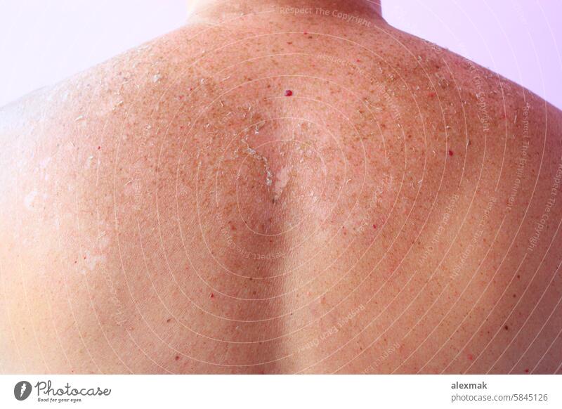 Spuren eines Sonnenbrands auf dem Rücken eines Mannes. Menschliche Haut nach einem Sonnenbad Körper Brandwunde verbrannt rot verbrühen rosa Krebs Sommer