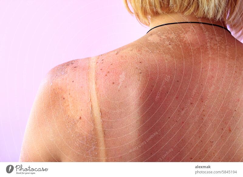Spuren eines Sonnenbrands auf dem Rücken einer Frau. Weiblicher Körper Brandwunde verbrannt Haut verbrühen rot rosa Krebs Sommer Allergie krebsartig Pflege