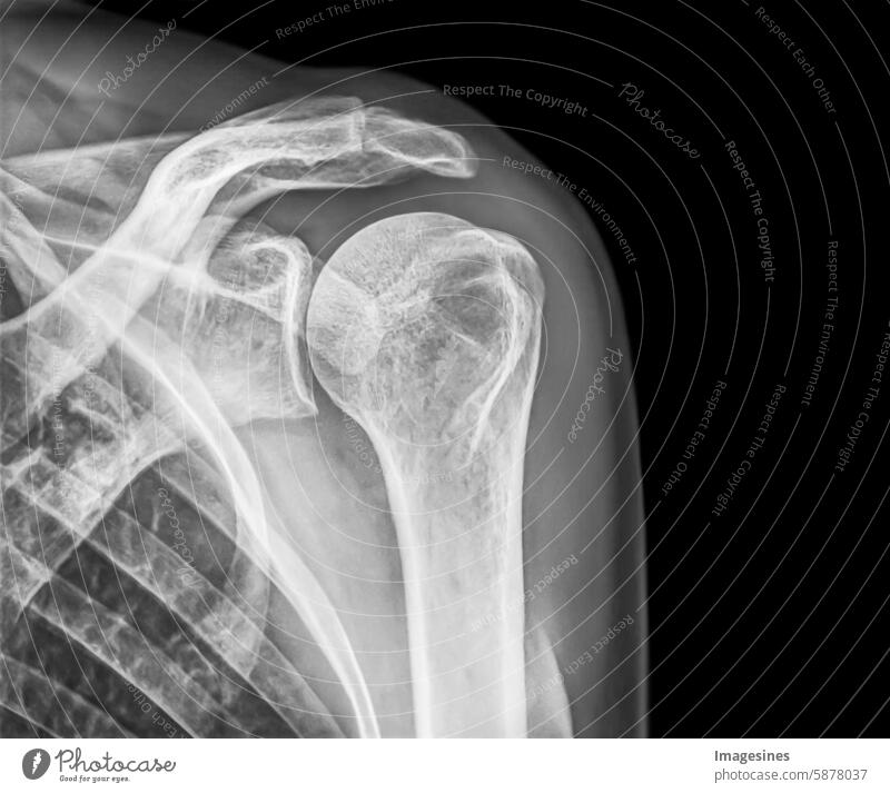 Patient mit Schulterschmerzen ohne Befund. Teil einer menschlichen weiblichen Schulter, hochwertige Röntgenaufnahme auf schwarzem Hintergrund in Blautönen. Medizinisches Konzept