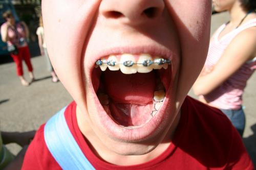 Mach's Maul Auf! Zahnspange Mädchen glänzend laut rot protestieren Außenaufnahme Gesundheit Wut Ärger Kind Mund offen silber Zunge Lippen schreien blau Haut