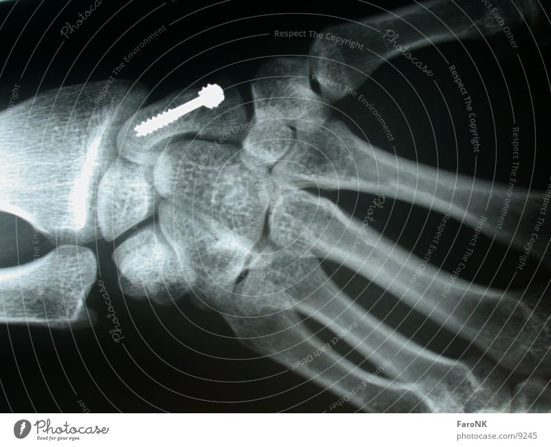 Verschraubt Schraube Hand Röntgenbild Skelett obskur Radiologie